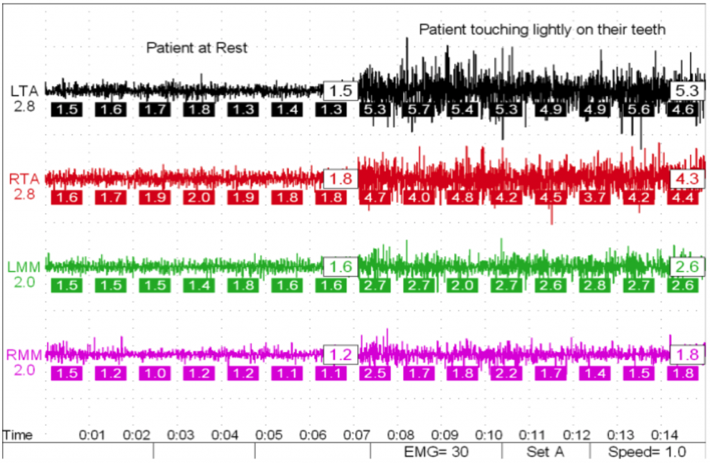 Muscle activity tracking.